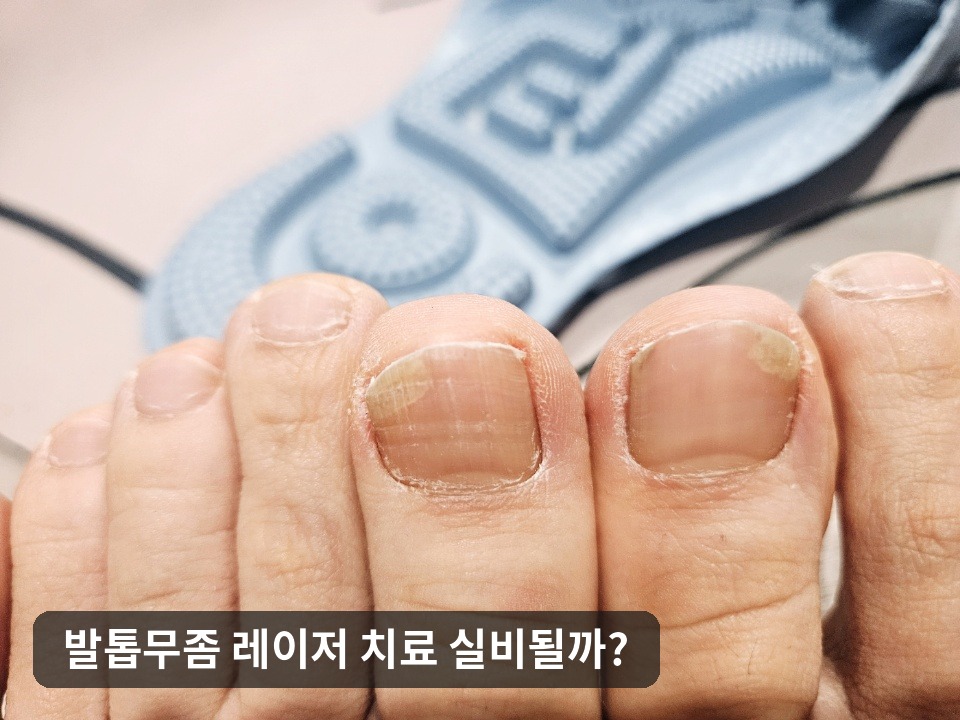 발톱무좀 의심 증상이 있는 발톱 사진
